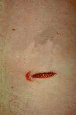 Stab wound with a 'hilt'